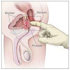 prostate treatment